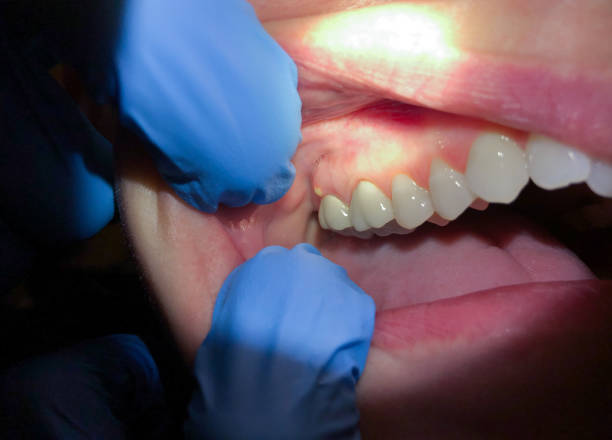 Best Emergency Dental Care for Broken or Chipped Teeth in Kittitas, WA
